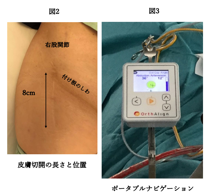 皮膚切開の長さと位置
ポータブルナビゲーション