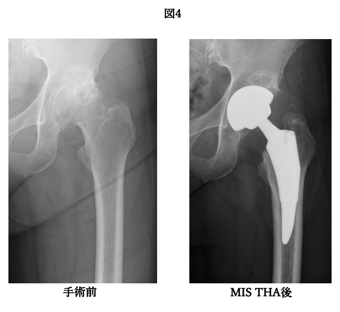 手術前
MIS THA後