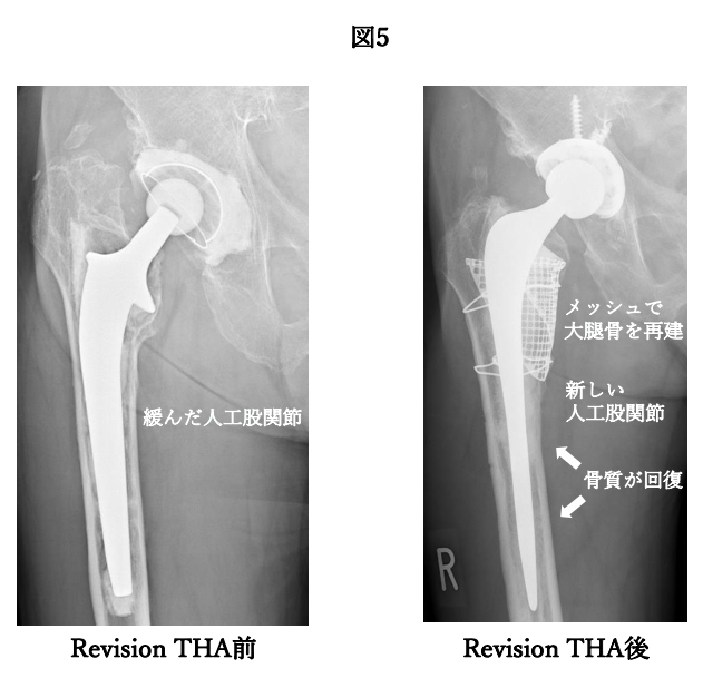 Revision THA前
Revision THA後