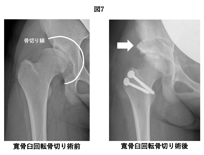 寛骨臼回転骨切り術前
寛骨臼回転骨切り術後