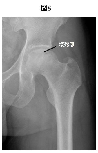 壊死部
