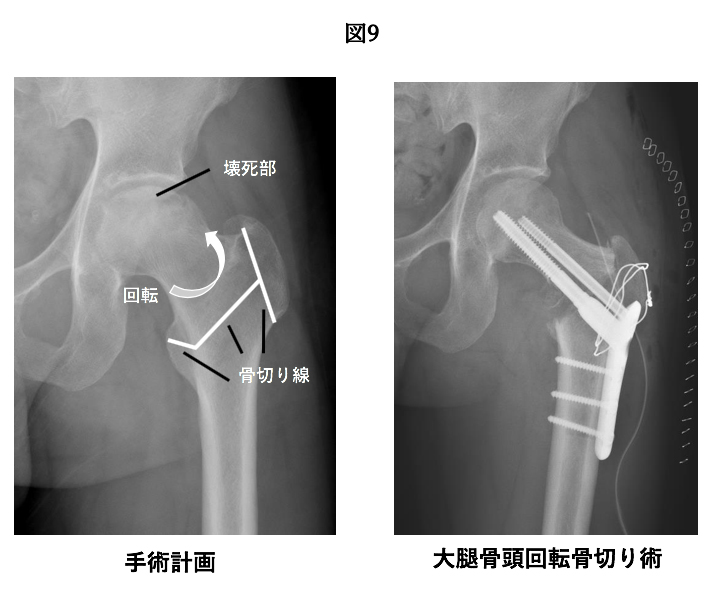手術計画
大腿骨頭回転骨切り術